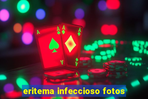 eritema infeccioso fotos